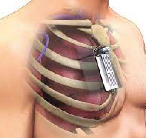 Ambulatory Spontaneous Pnuemothorax